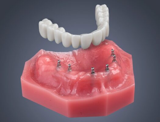 Non-Removable Fixed Implant Dentures