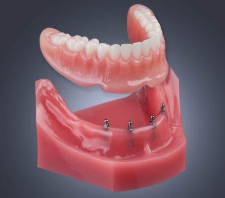 Implant Supported Dentures - Implant Denture