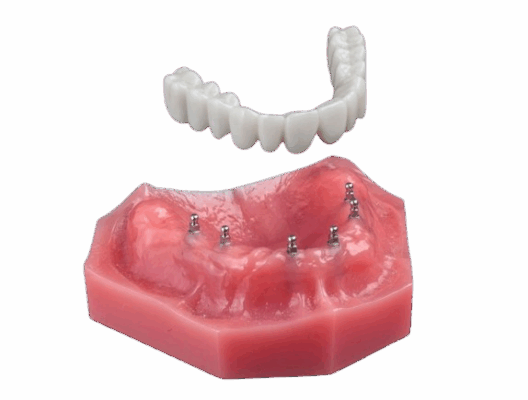 All-on-4 Alternatives in Atkins, AR | Free Implant Consultations