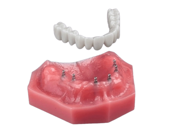 All-on-4 Alternatives in Atkins, AR | Free Implant Consultations