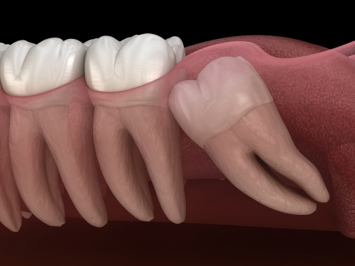 Wisdom Teeth Extraction in Atkins, AR | Protect Your Smile Today!