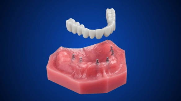 Permanent Dentures in Atkins, AR | Book a Free Consultation!