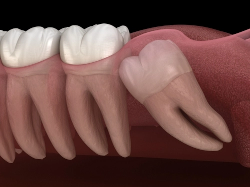 Wisdom Teeth Extraction in Atkins, AR | Protect Your Smile Today!