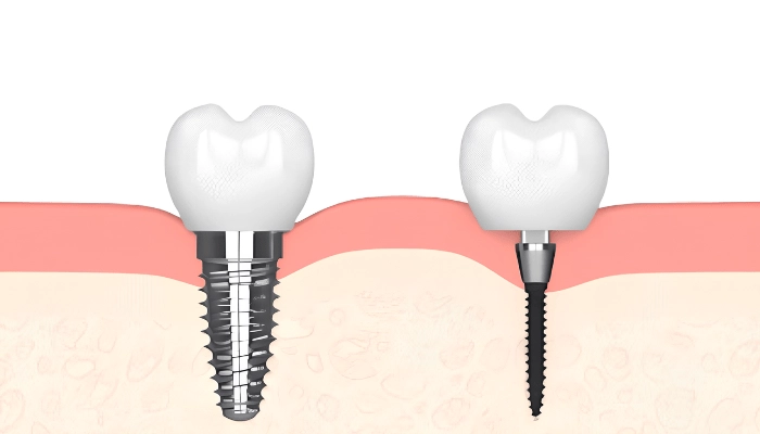 Dental Implants in Pottsville, AR | Restore Your Smile Today!3