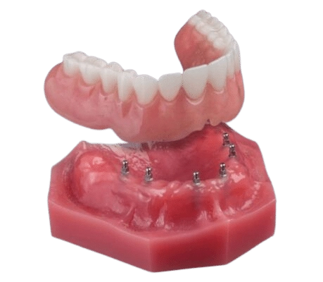 Snap-On Dentures in Atkins, AR | Ask Us About Mini Implants!