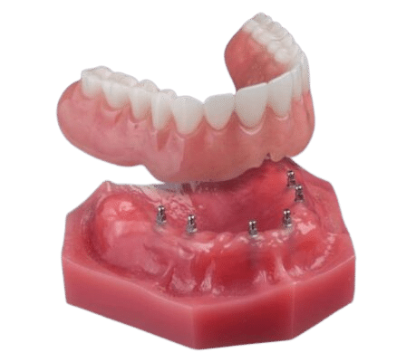Snap-On Dentures in Atkins, AR | Ask Us About Mini Implants!