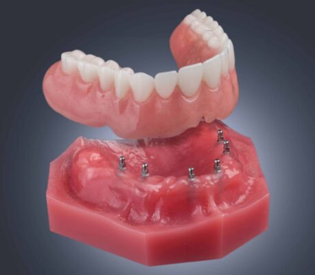 Denture Stomatitis | Mini Implant Dentures in Atkins, AR