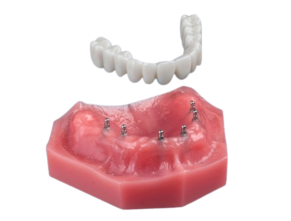 All-on-4 Alternatives in Atkins, AR | Free Implant Consultations