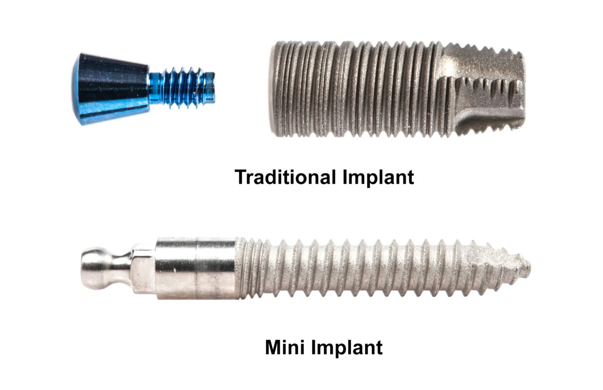 Mini Implants in Atkins, AR | Book a Free Implant Consultation!