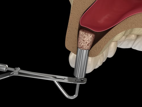 Sinus Lift and Bone Grafting | Mini Dental Implants in Atkins, AR