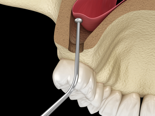 Sinus Lift and Bone Grafting Mini Dental Implants in Atkins, AR