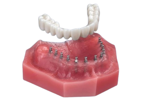 Full Arch Teeth in Atkins, AR | Affordable Mini Implant Solutions