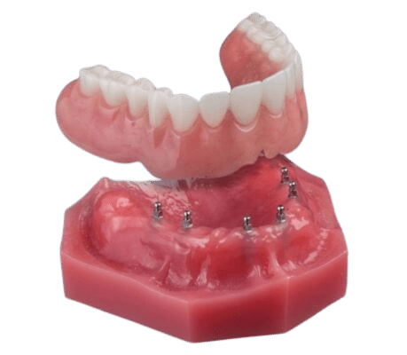 Implant Surgery | Minimally Invasive Dental Implants in Atkins, AR