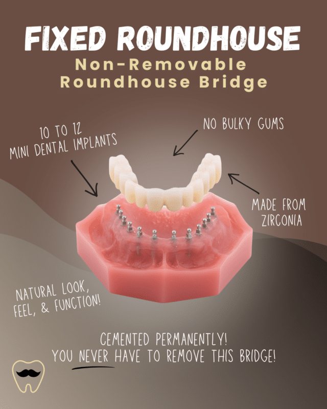 Full Mouth Implants in Atkins, AR | Free Implant Consultations