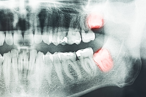 Wisdom Teeth Extraction in Atkins, AR | Affordable Care Near Me