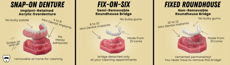 Full Arch Implants in Russellville, AR | Implant Denture Options