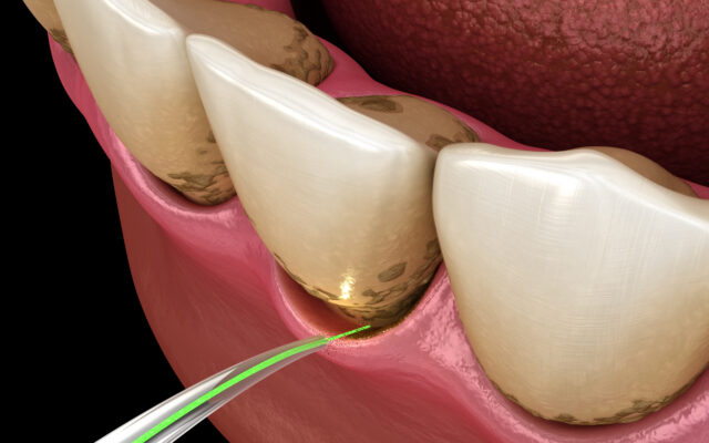 Laser Assisted Periodontal Therapy in Atkins | Treat Bleading Gums