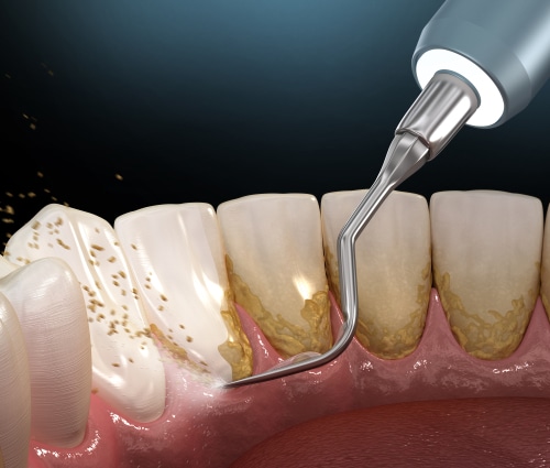 Deep Cleaning Teeth | Gum Disease Treatment in Atkins, AR